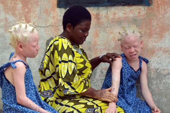 Congo crèmes solaires albinos